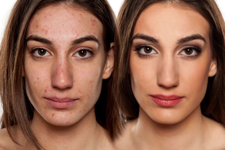 bad skin